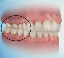 Posterior Crossbite