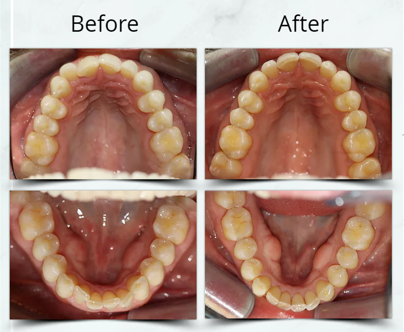 Express Invisalign