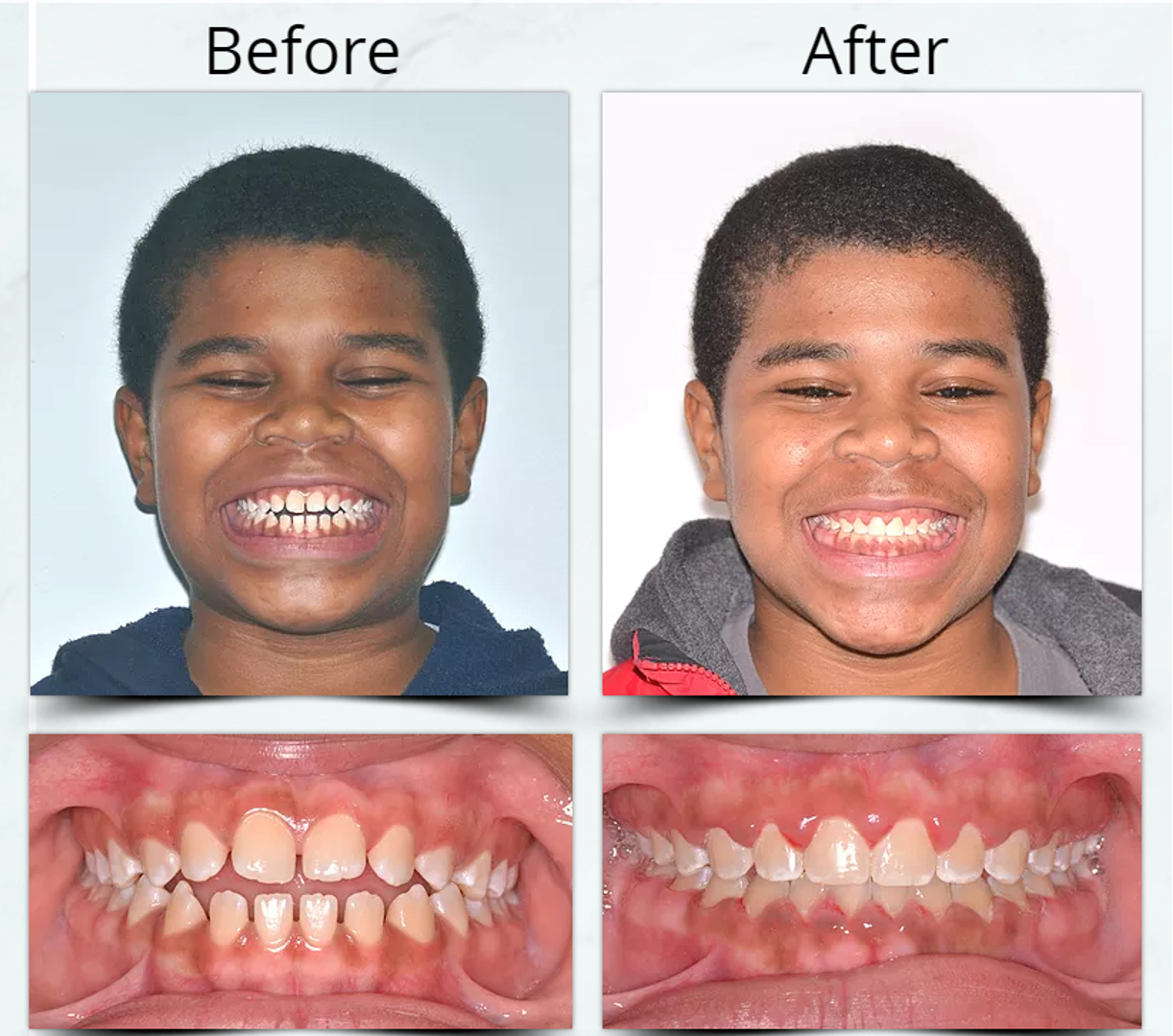 Open Bite Treatment