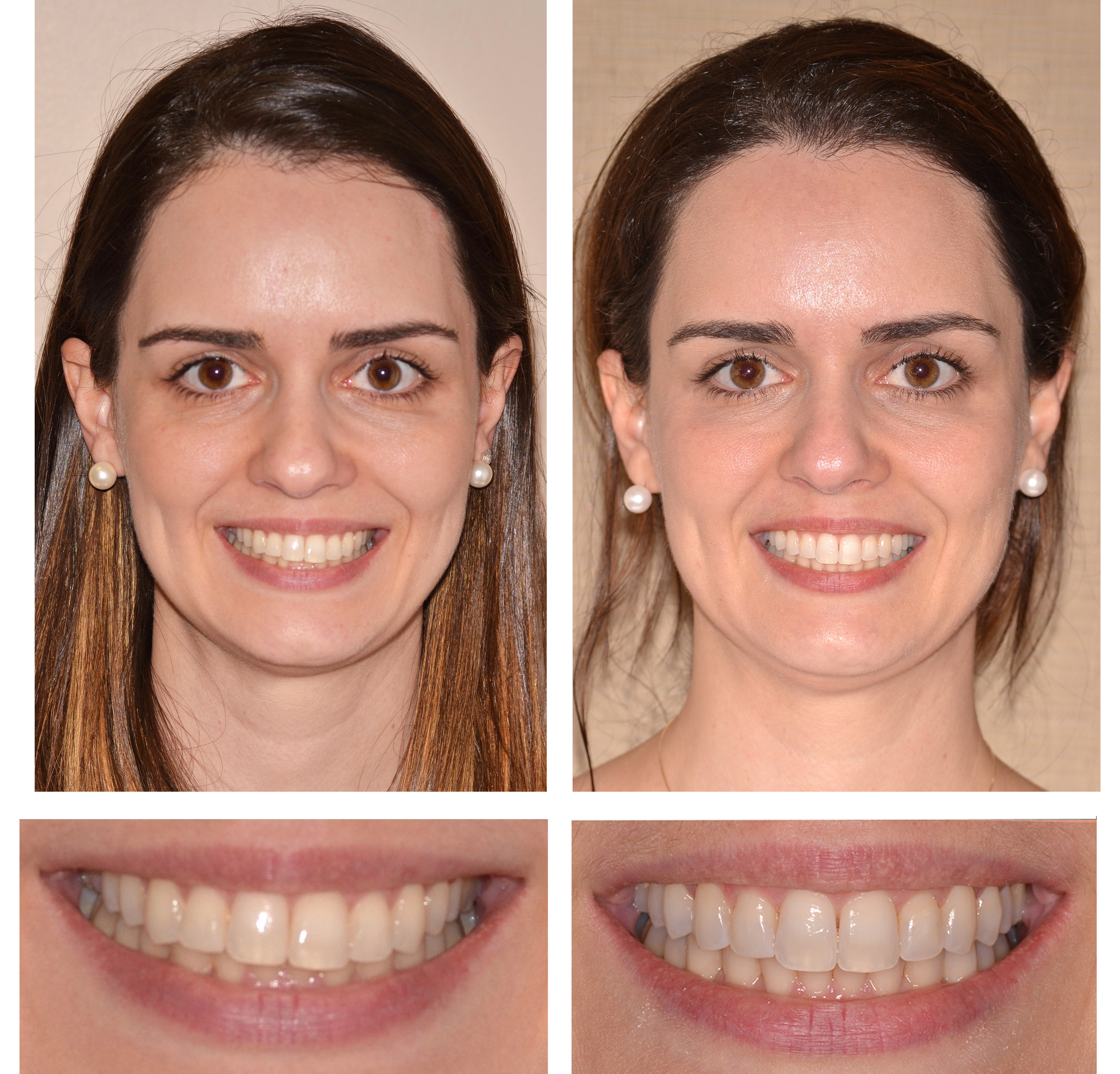 Occlusal Cant Correction