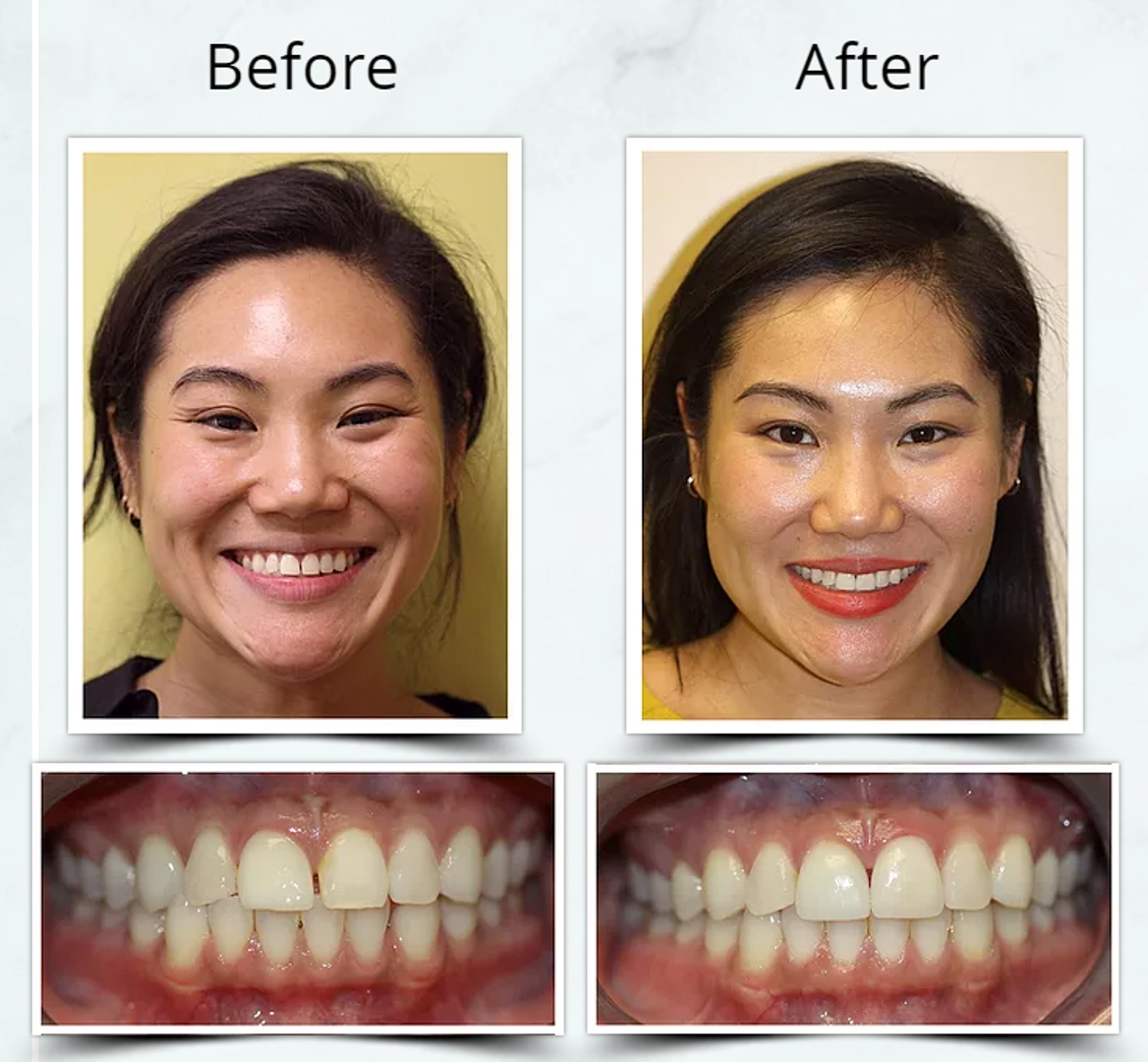 Invisalign Combined Treatment