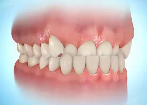 Anterior Crossbite Appliance_edited