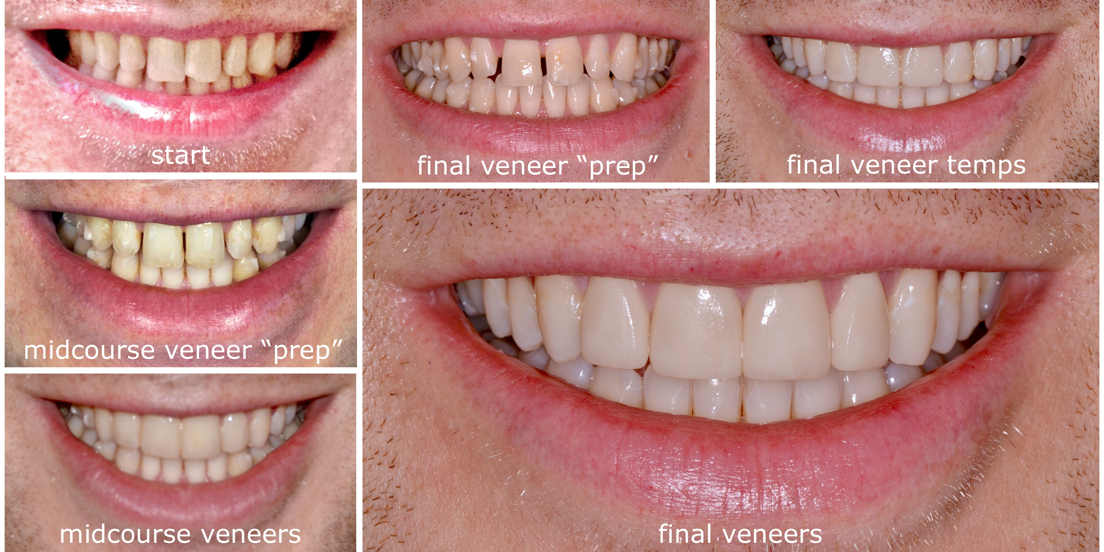 Conservative "No-Prep" Veneers