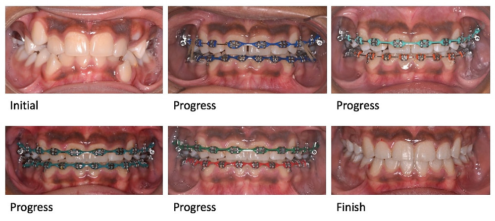 Extraction treatment for severe crowding