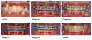 Extraction treatment for severe crowding