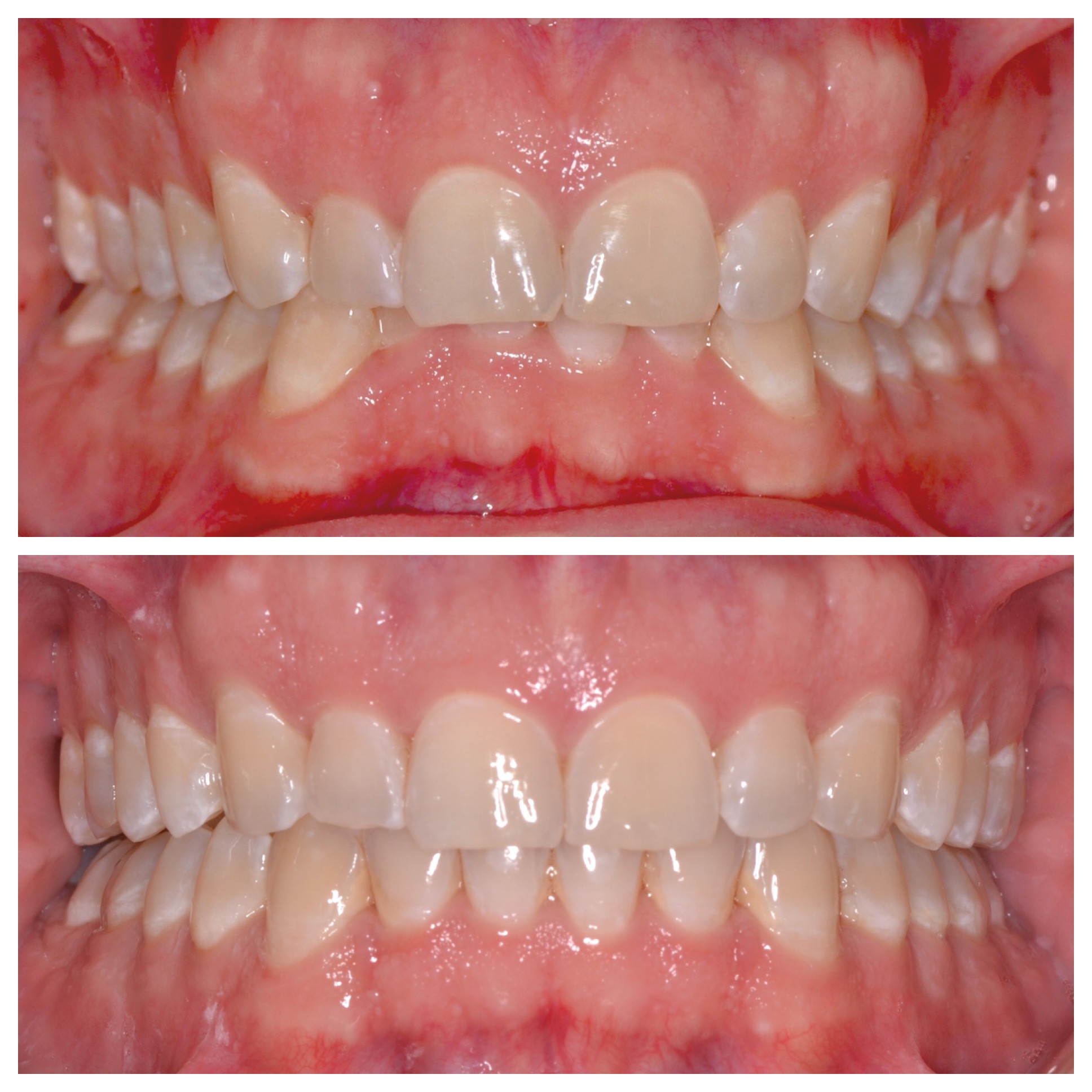 Deep Bite Invisalign Treatment