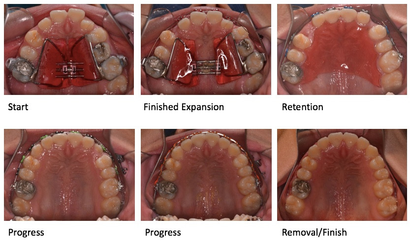 Impacted canine expansion treatment