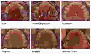 Impacted canine expansion treatment