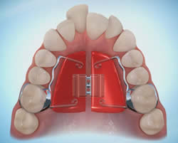 Palatal Expanders