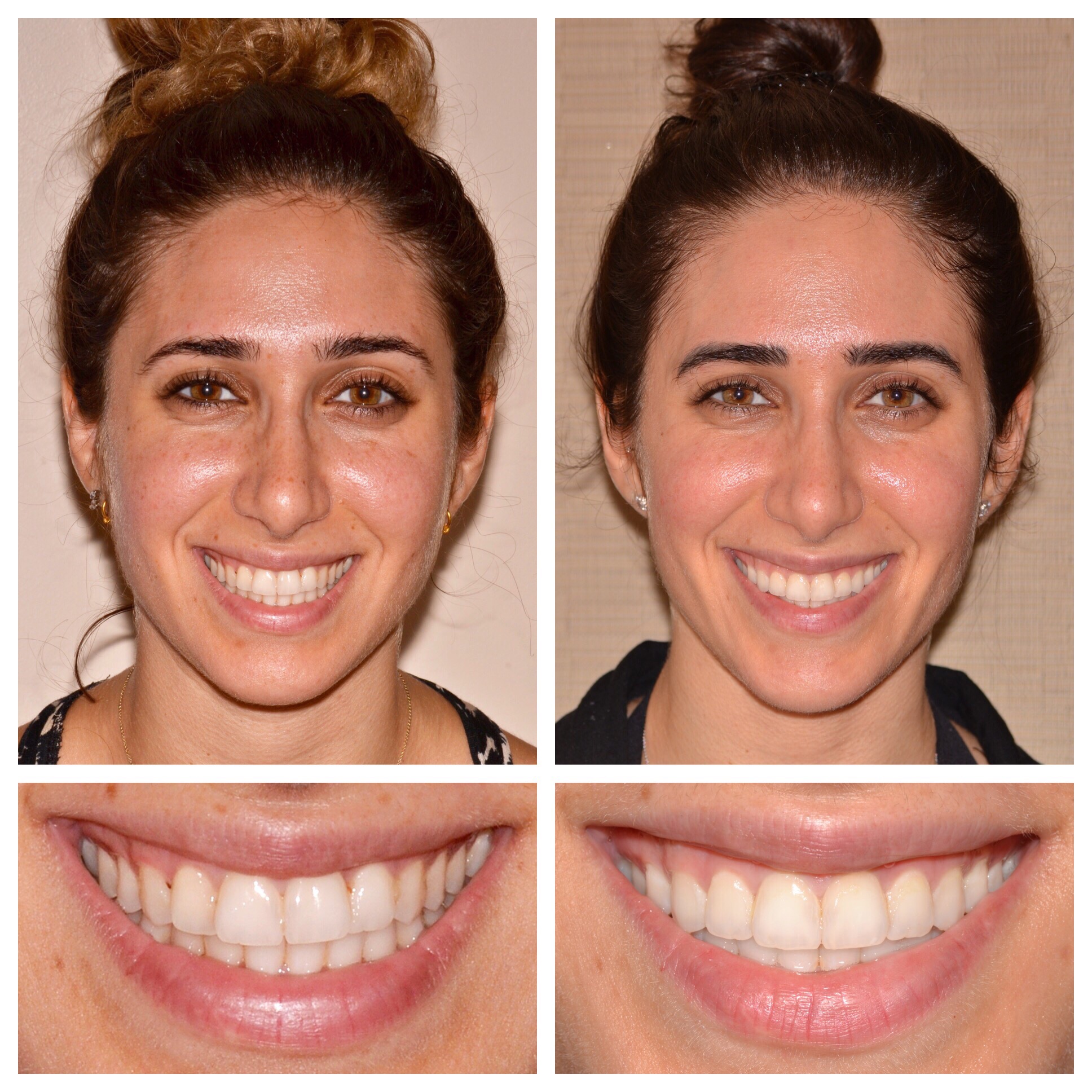 Invisalign Treatment