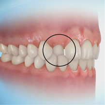 Dental Crossbite