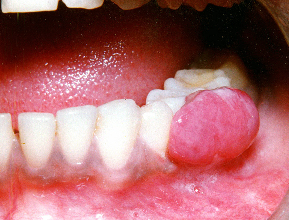 pregnancy tumor granuloma