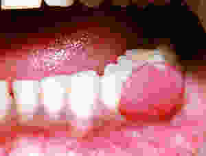 pregnancy tumor granuloma