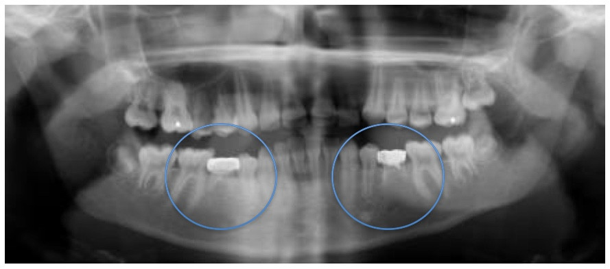 Missing permanent 2nd premolars