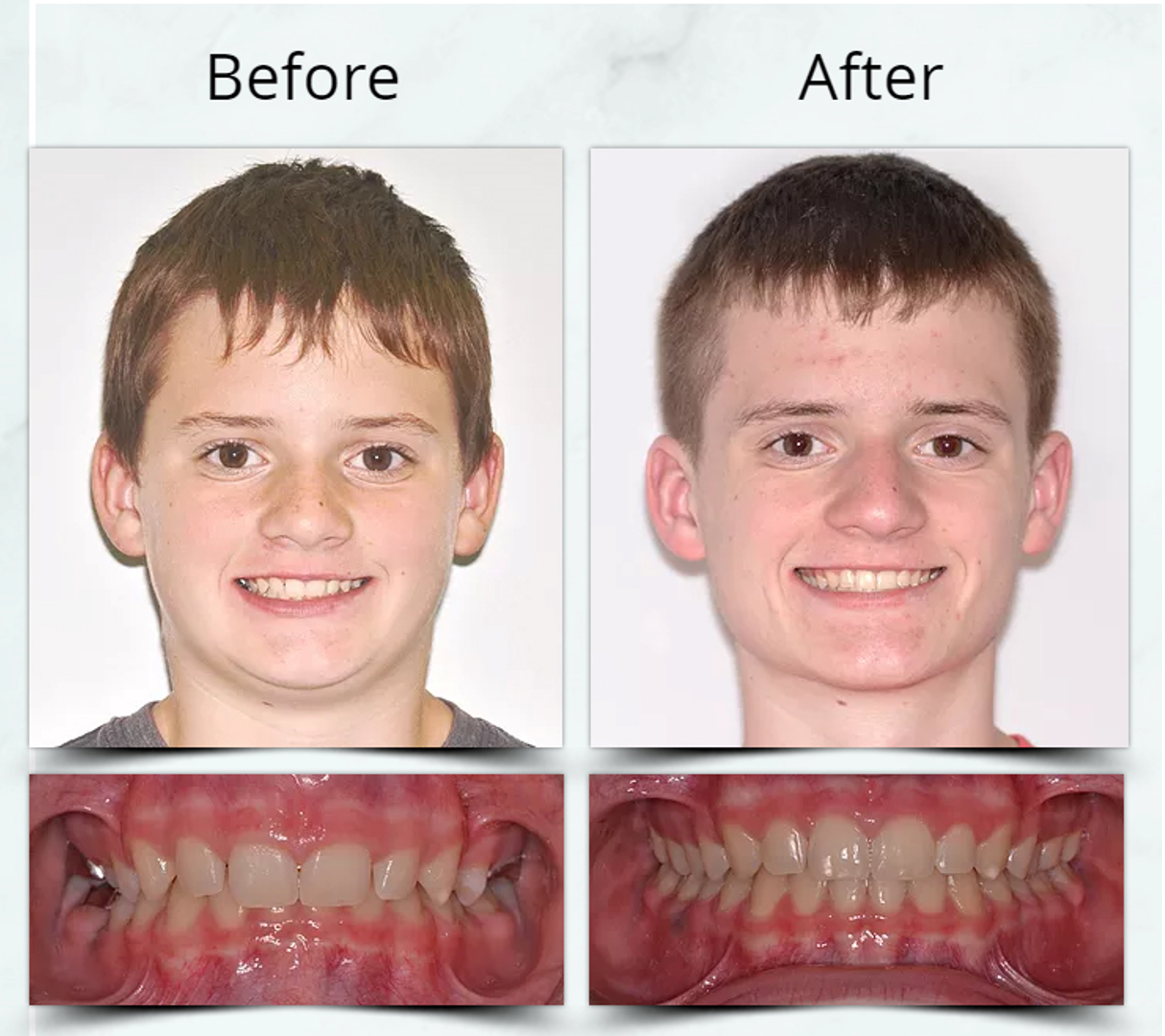 Deep Bite Treatment