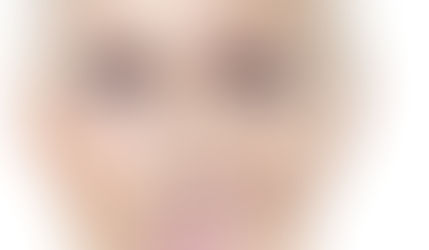 Bọng mỡ mí trên – nỗi ám ảnh của tuổi trung niên