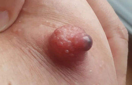 Pérolas de leite na amamentação: o que são e como lidar com elas?