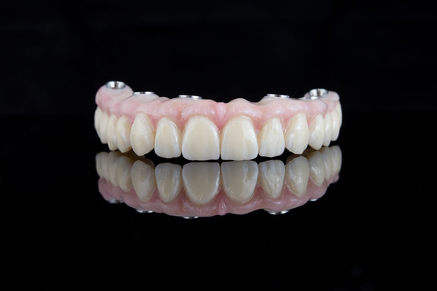 quality-dental-prosthesis-made-titanium-beam-ceramics-fixation-upper-jaw.jpg