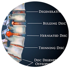 Levittown, PA Chiropractor, Spinal Disc Problems, Back Pain, Dr. Mike Frezza