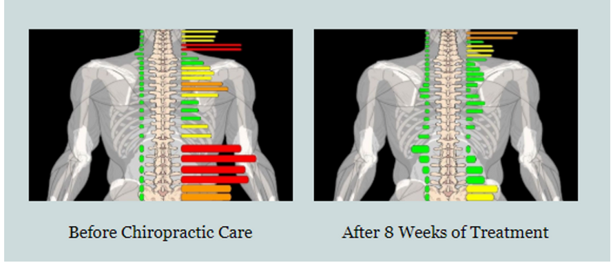 Tytron Theromography chiropractic