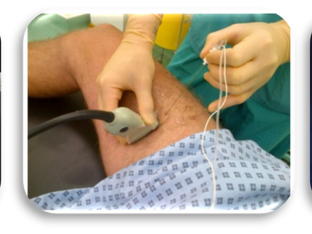 Advances in Popliteal, Adductor Canal, and Ankle Blocks