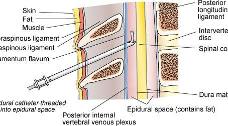 Epidural Strategies