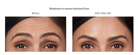 BOTOX Cosmetic A.png