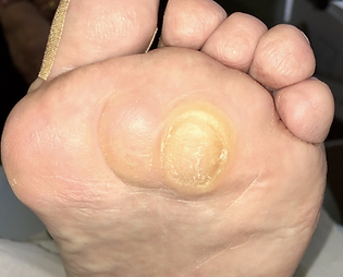 a corn on a foot