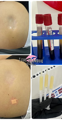 Bio plasma filler results at Love Glamour Aesthetics