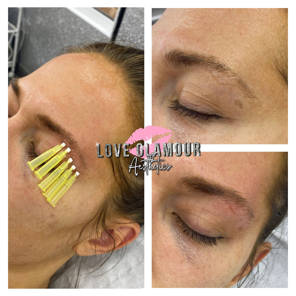 eyebrow lift mono threads