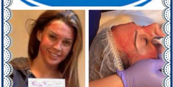 Celebrity Microneedling Skin Rejuvenation Treatment