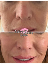 Cheak filler results romford Love Glamour aesthetics