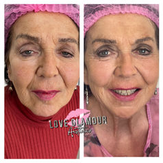Before and after PDO thread lift treatment showing facial lifting and skin rejuvenation results on mature client