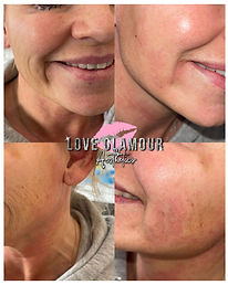 Exosome facial before and after results improving skin texture and glow