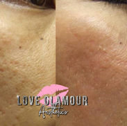 Before and after chemical peel treatment showing improvement in acne scars and uneven skin texture