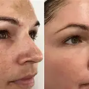 Before and after chemical peel treatment showing brighter skin tone and smoother skin texture