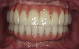 Full mouth dental implant reconstruction before after transformation Precision Dental Weston