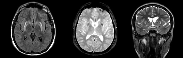 ¿Cómo afecta el Parkinson a la memoria?