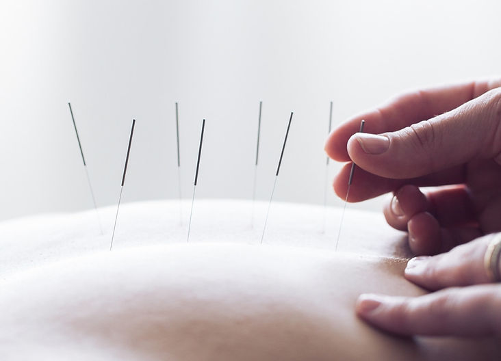 acupuncture.jpg