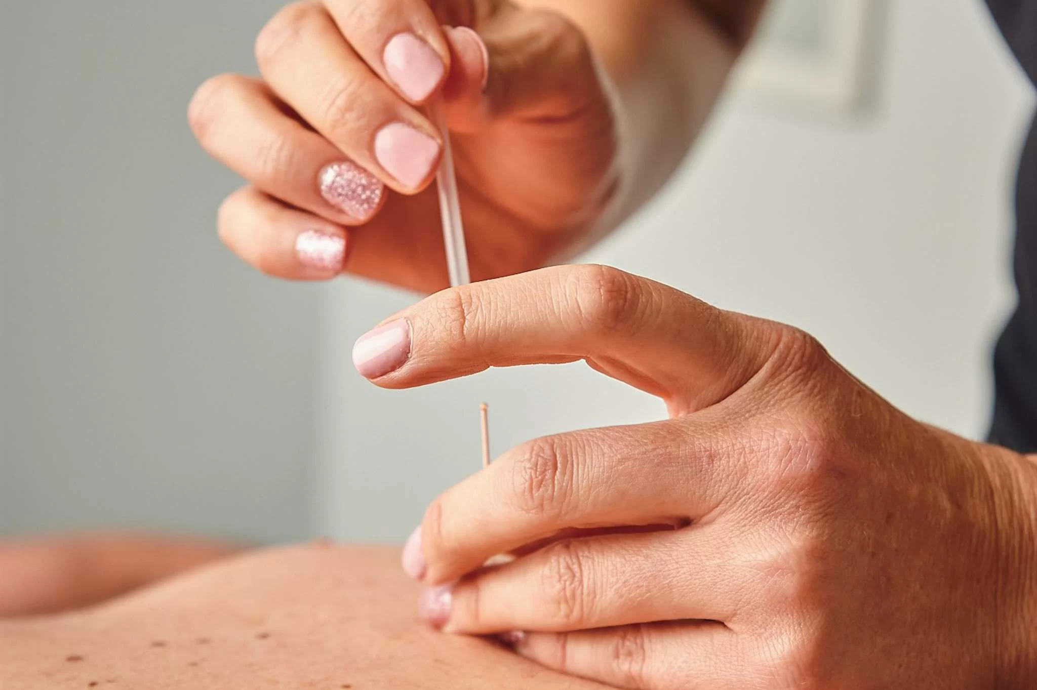 Physiotherapy-Dry-Needling-Cropped.webp
