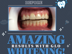 Brighten Your Smile with Glo® Teeth Whitening