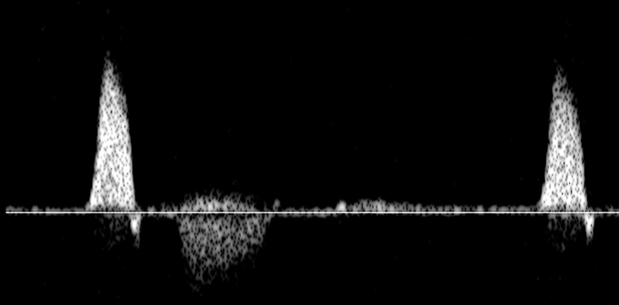 IMAGE8_Ultrasound_F3-AV-VAo flow.tif