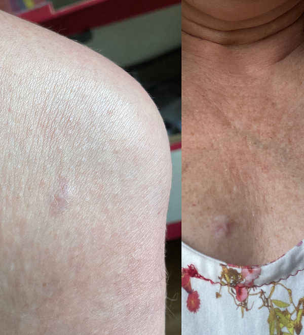 Mole experiment by bad skin specialist s.jpg