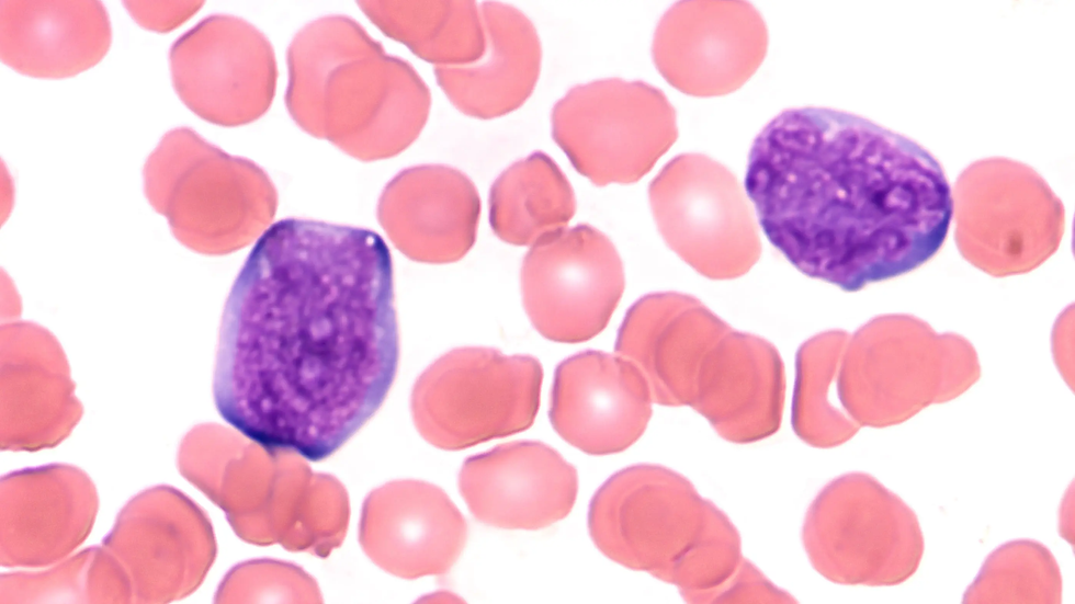 Acute_Lymphatic_Leukemia_ALL-Hyperthermia-Centre-Hannover-Germany