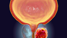 Der Einfluss von Curcumin auf die Metastasenbildung im Prostatakarzinom