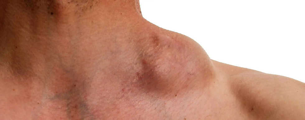 Lymphome-de-Hodgkin-maladie-de-Hodgkin-traitement-Centre-d-Hyperthermie-de-Hanovre