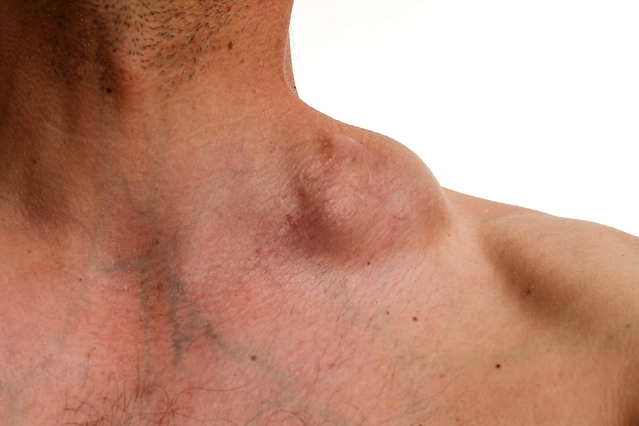 Hodgkin_Disease_Hyperthermia_Centre_Hannover.webp