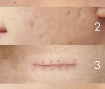 Le Langage Secret de la Peau : Ce que vos Cicatrices Racontent de vos Émotions