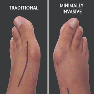 bunionectomy LOGO.gif