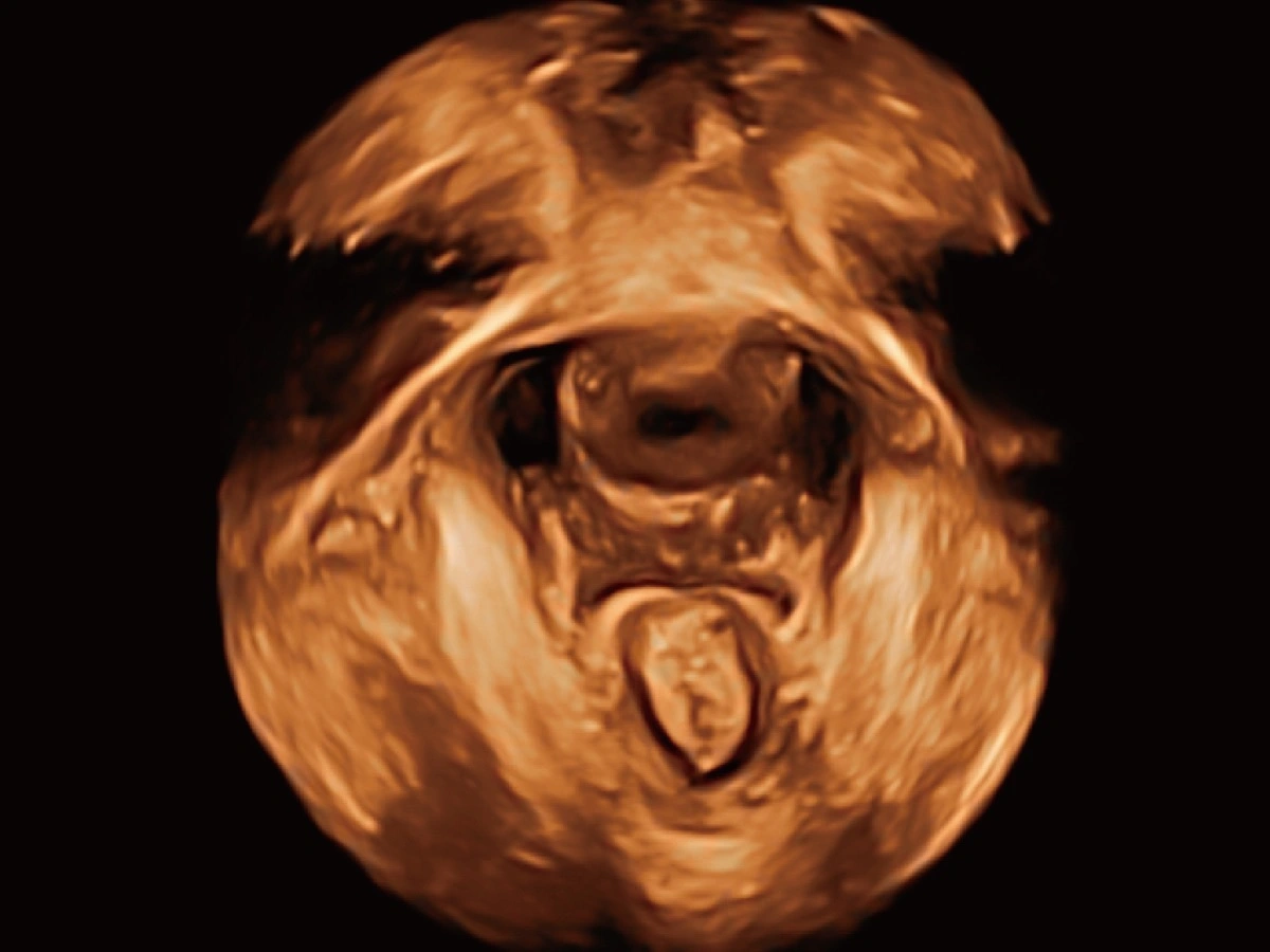 S-Pelvic
